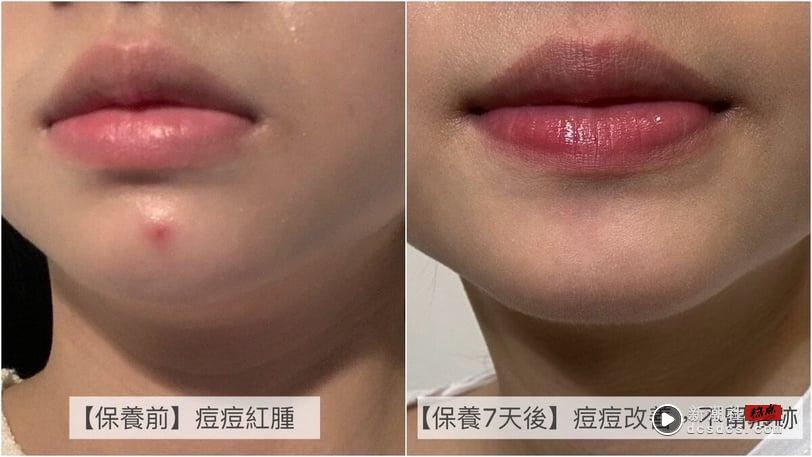 断崖式分手痘痘！贝肤黛玛“3D水杨酸”调理皮脂关键，养成粉刺痘痘绝缘体！ 最新 图2张
